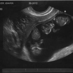 wow-11-week-twin-ultrasound-21268701-255B1-255D-300x2281